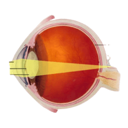 Hyperopia (Farsightedness)