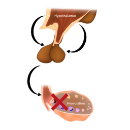 Hyperprolactinemia