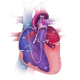 Hypoplastic Left Heart Syndrome (HLHS)