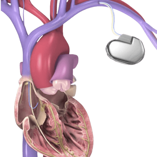 ICD İmplantı