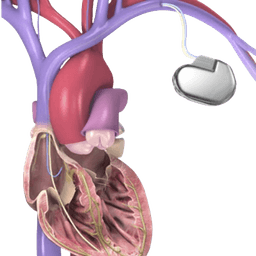 ICD Implant