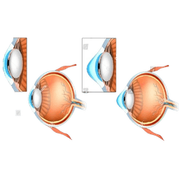 Intacs Corneal Implants