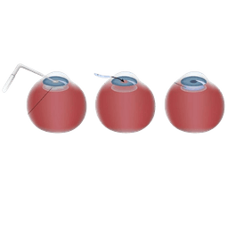 Intraocular Implants