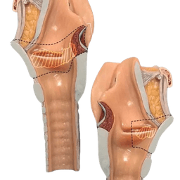 Laryngectomy