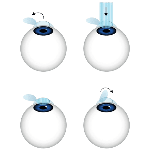 LASIK amaliyoti