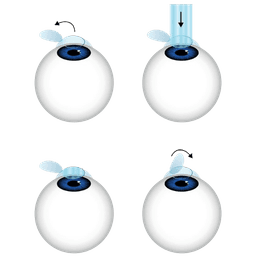 LASIK Procedure