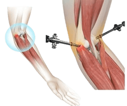 Lateral Epicondyle release (Tennis Elbow)