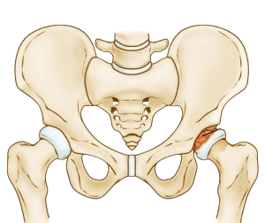 Legg-Calve-Perthes kasalligi - LCPD