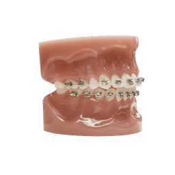 Lingual Braces