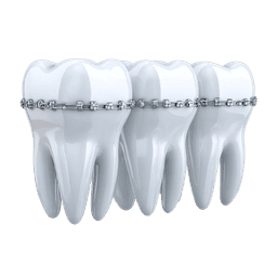 Metal Braces