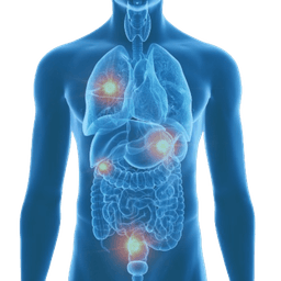 Metastatic Tumors