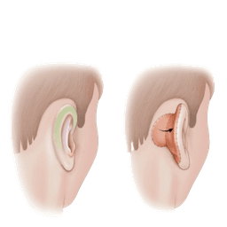 Microtia Surgery