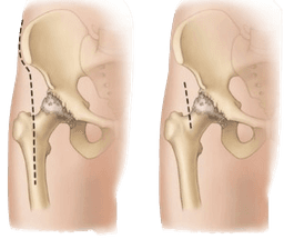 Minimally Invasive Hip Resurfacing