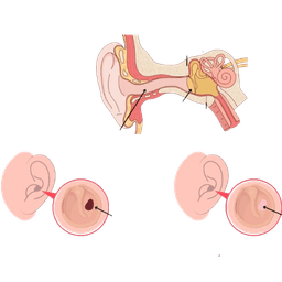 Myringoplasty