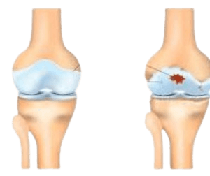 Osteoartrit - Stem cell (O'zak hujayra)