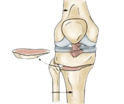 Osteotomy Surgery (Bone Realignment Surgery)