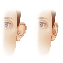 Otoplasty