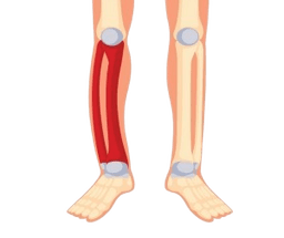 Paget's Disease