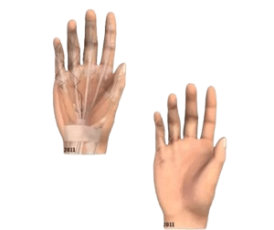 Palmar Fastsektomiya