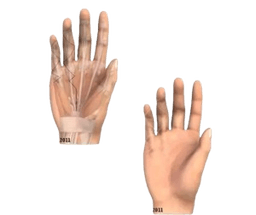 Palmar Fasciectomy