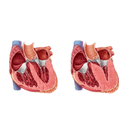 Pediatric Cardiomyopathy