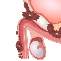 Penile Cancer