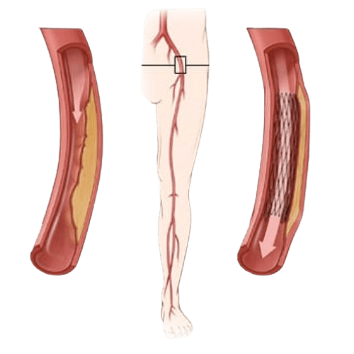 Periferik angioplastika