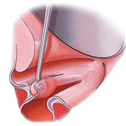 Phonosurgery