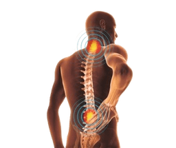 Prolapsed Disc