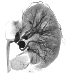 Renal Angiogram