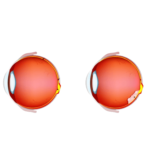 Retinoblastoma-RB