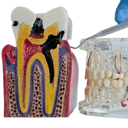 Root Canal