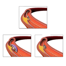 Rotational Atherectomy