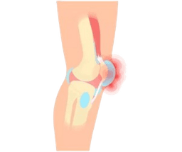 Septic Arthritis