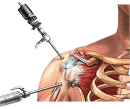 Shoulder Arthroscopy
