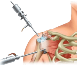 Shoulder Labral Tear Surgery (Arthroscopic Labrum Repair)