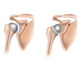 Shoulder Replacement Surgery