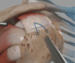 Shoulder Rotator Cuff Repair