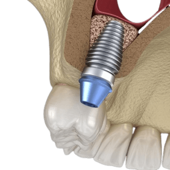 Sinus Lift Operatsiyasi - Sinus Augmentatsiyasi