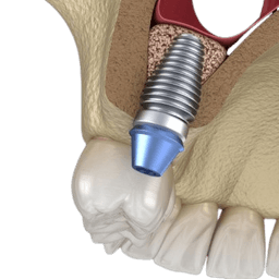 Sinus Lift Surgery - Sinus Augmentation