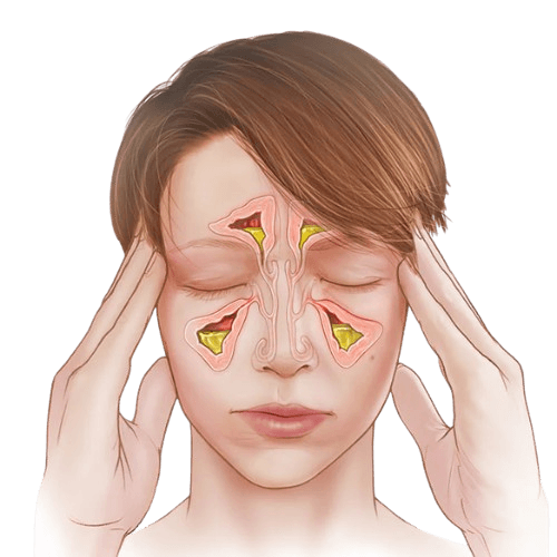 Sinusit (sinus infeksiyasi)