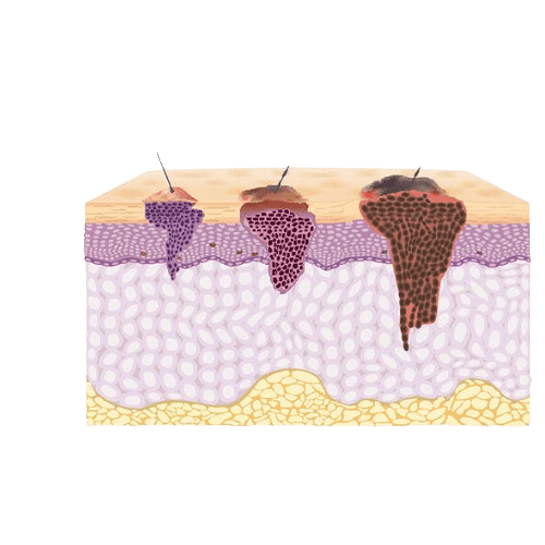 Teri saratoni — Melanoma
