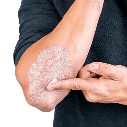Skin Lymphoma