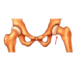 Slipped Capital Femoral Epiphysis-SCFE