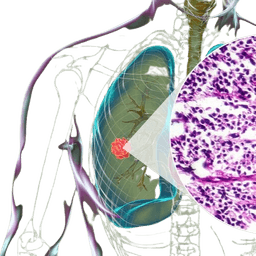 Small Cell Carcinoma