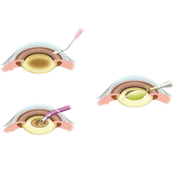 Small Incision Cataract Surgery (SICS)