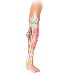Soft Tissue Sarcoma