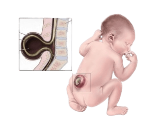 Spina Bifida
