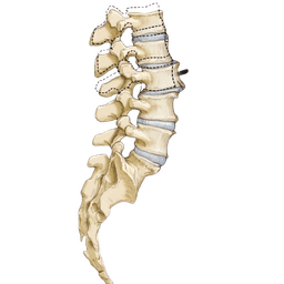 Spondylolisthesis