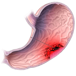 Stomach Cancer